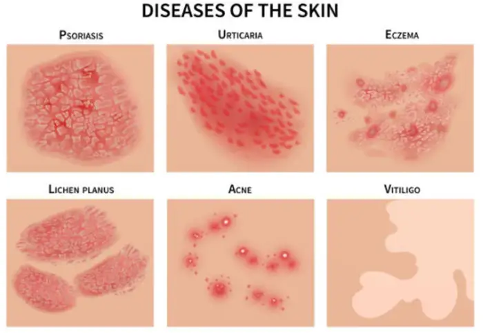 Demistificazione dei fattori scatenanti e della gestione dell'eczema